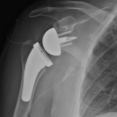 Reverse Total Shoulder Replacement .